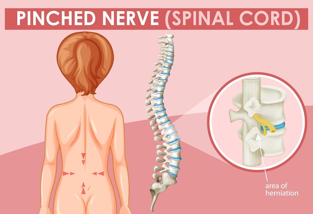 Diagram showing pinched nerve in human