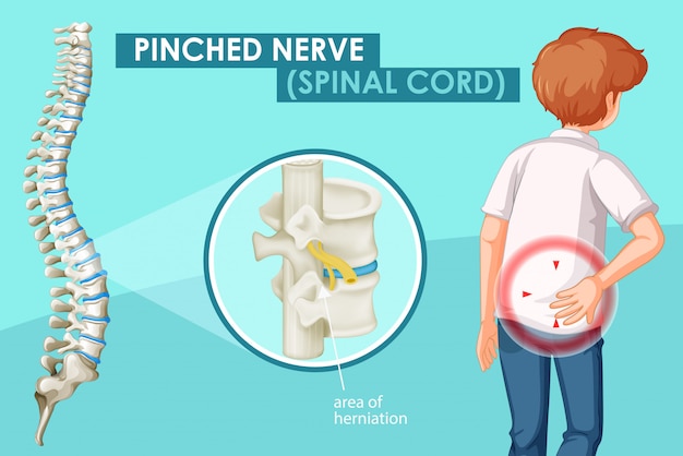 Free vector diagram showing pinched nerve