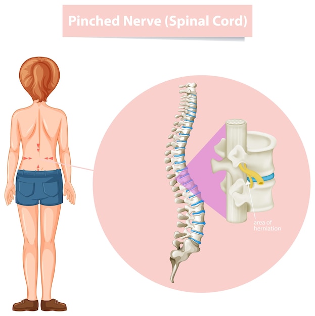 Free vector diagram showing pinched nerve