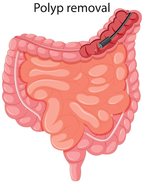 Free vector diagram showing polyp removal