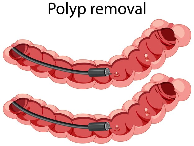 Diagram showing polyp removal