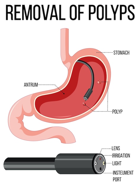 Free vector diagram showing removal of polyps