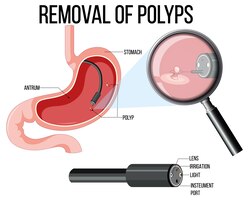 Diagram showing removal of polyps