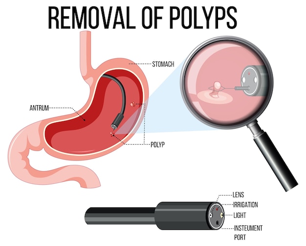 Diagram showing removal of polyps