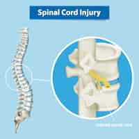 無料ベクター 脊髄損傷を示す図