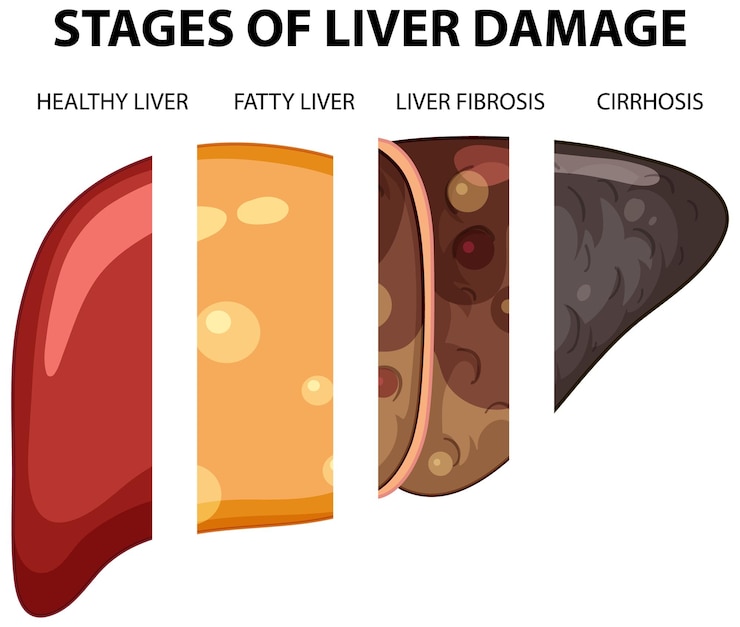 Free Vector diagram showing stages of liver damage