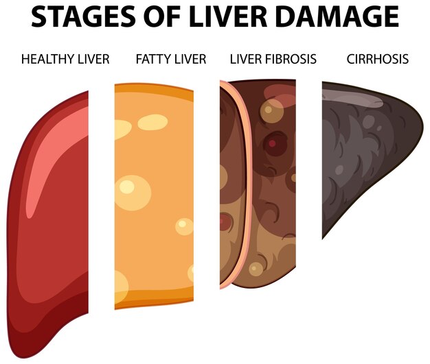 Diagram showing stages of liver damage