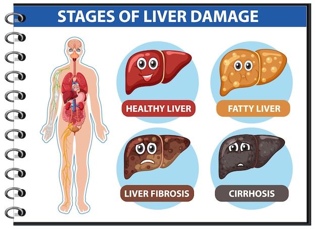 Diagram showing stages of liver damage