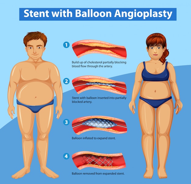 Diagram showing stent with balloon angioplasty