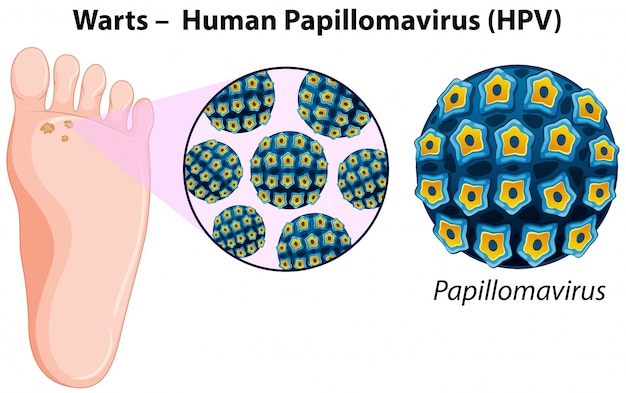 Diagram showing warts in human foot