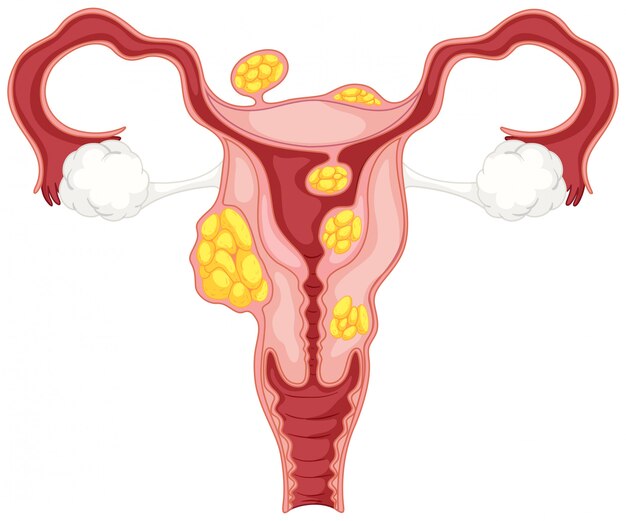 아랫배 자궁 자궁 근종의 다이어그램