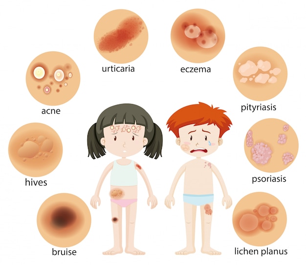 Бесплатное векторное изображение Различные кожные заболевания на девочке и мальчике
