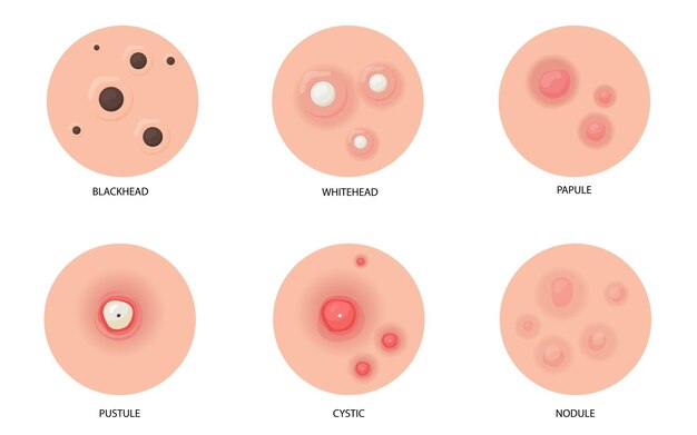 さまざまな種類のにきびフラットセット