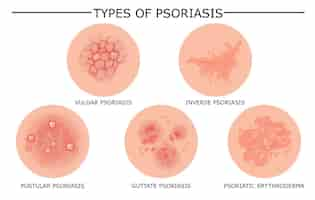 Free vector different types of psoriasis set