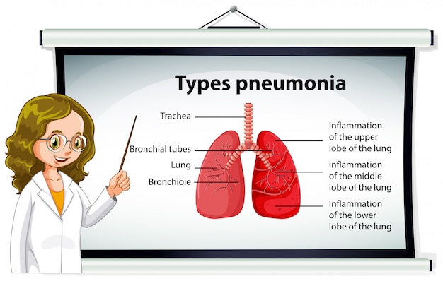 Vettore gratuito medico che spiega i tipi di polmonite