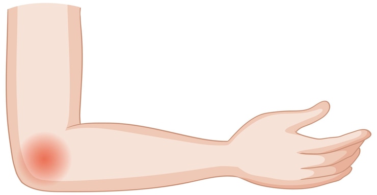 Free Vector elbow pain illustration