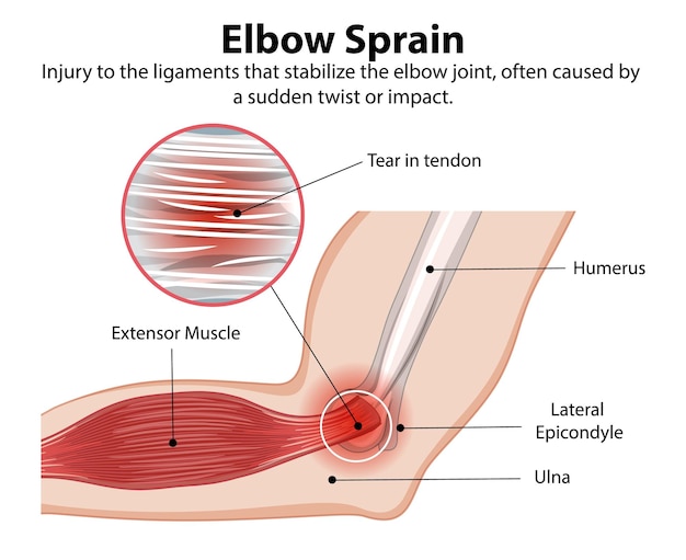 Free vector elbow sprain anatomy illustration