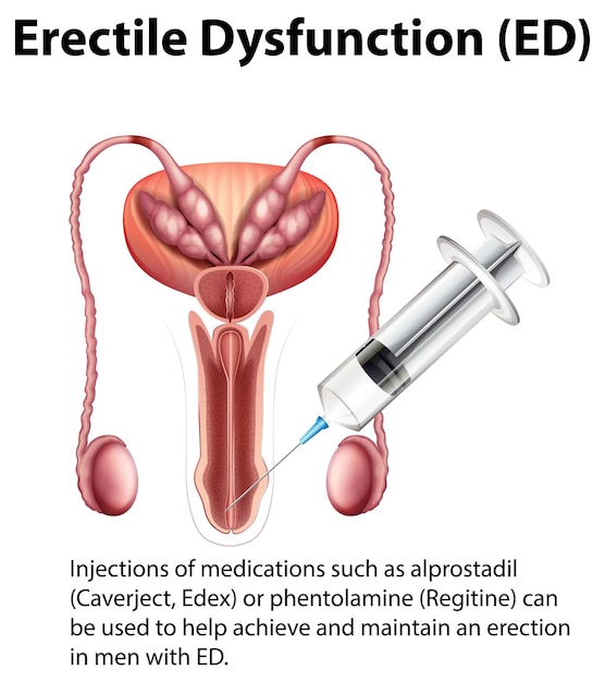 Vettore gratuito disfunzione erettile ed infografica con spiegazione