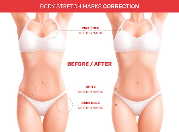 Free vector female woman body stretch marks realistic composition with editable text pointers and before after correction views vector illustration