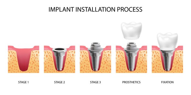 現実的に隔離された歯科インプラント設置の5つの段階