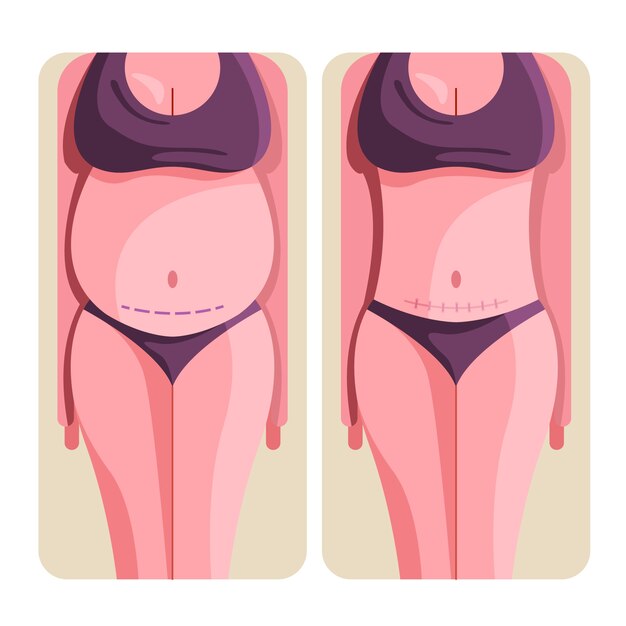 Flat design cesarean section