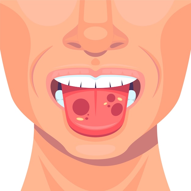 Free vector flat design stomatitis illustration