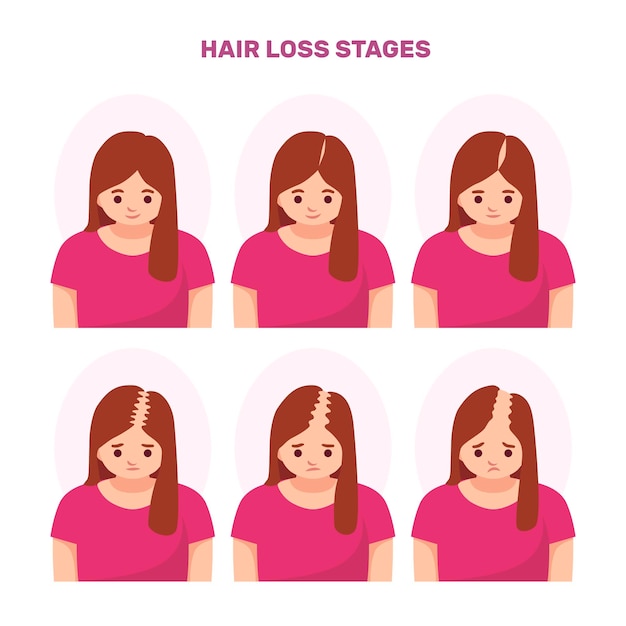 Free vector flat-hand drawn hair loss stages collection