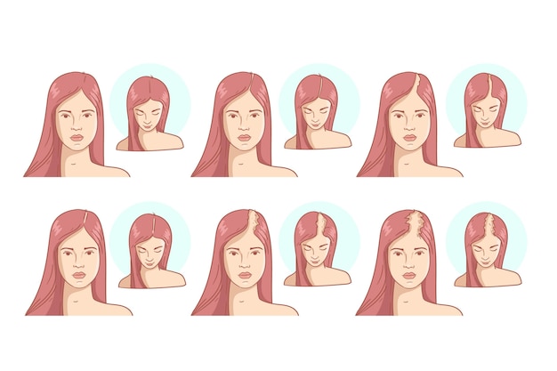 Free vector flat-hand drawn hair loss stages illustration
