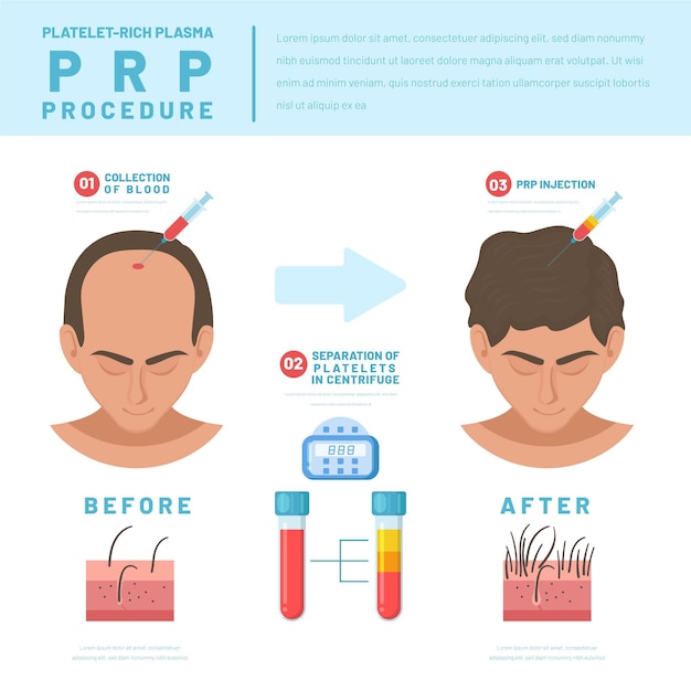 Плоская рисованная инфографика процедуры prp