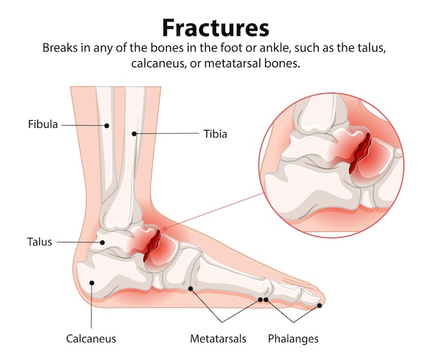 Free vector foot and ankle fracture diagram