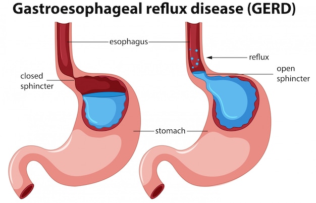 Gastroesophageal reflux disease anatomy