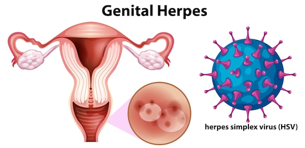 Free vector genital herpes with herpes simplex virus hsv