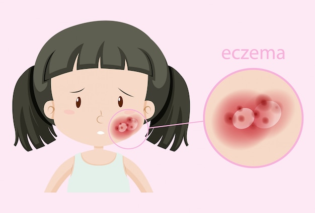 Free vector girl with eczema on face