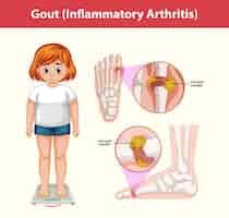 Free vector gout (inflammatory arthritis) medical information