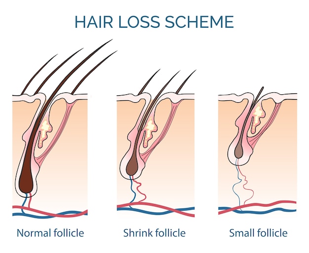 Schema di perdita dei capelli. perdita di capelli, problemi di crescita dei capelli, capelli sani. illustrazione vettoriale