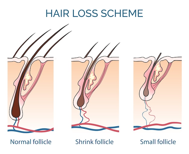 Схема выпадения волос. Выпадение волос, проблема роста волос, здоровье волос. Векторная иллюстрация