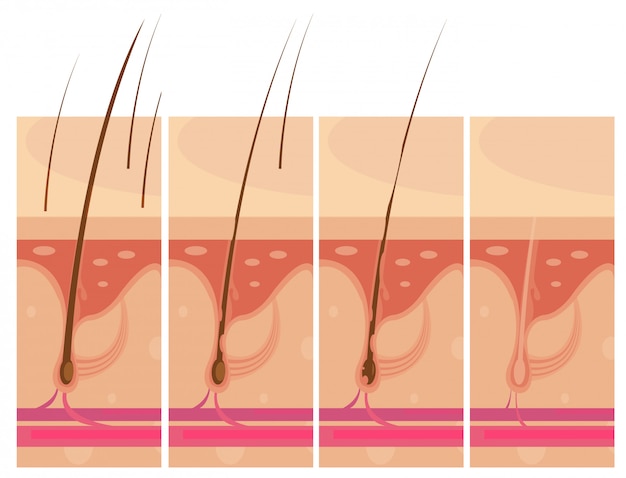 Le composizioni concettuali di storyboard di perdita di capelli hanno impostato