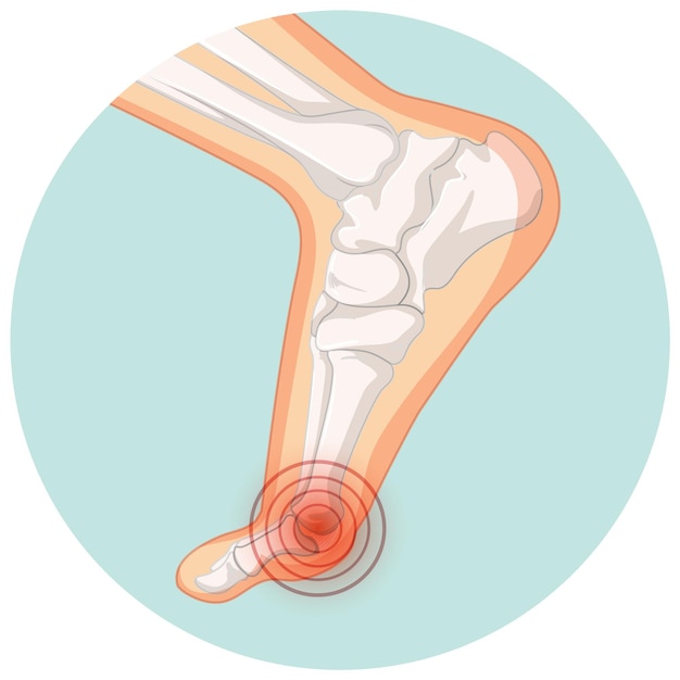 Типы Hallux valgus в шаблоне круга