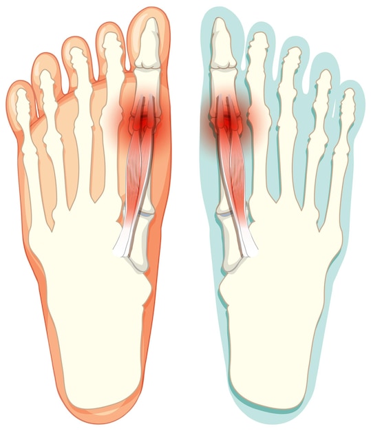 Free vector hallux valgus types on white background