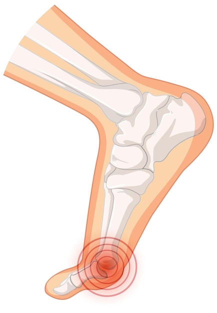 Типы Hallux valgus на белом фоне