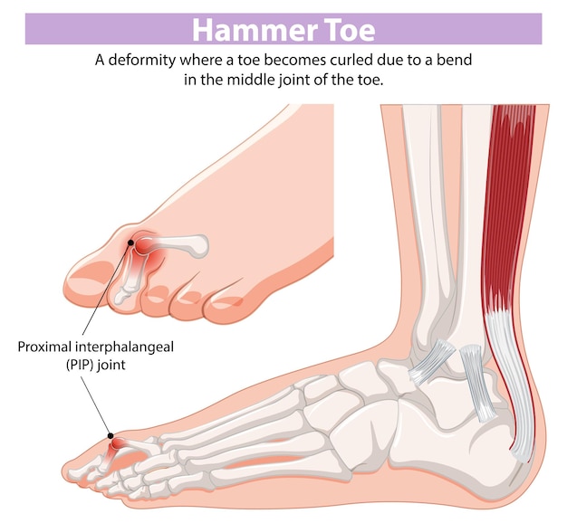 Free vector hammer toe medical illustration