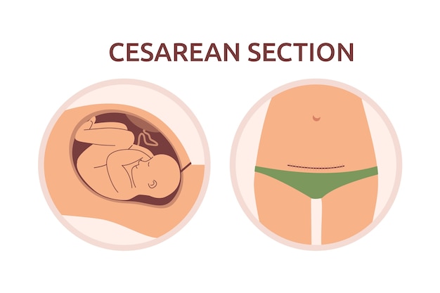 Hand drawn cesarean section incision