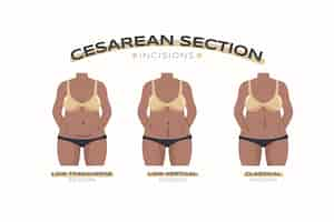 Free vector hand drawn flat design cesarean section