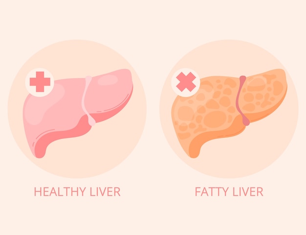 Free vector hand drawn flat design fatty liver illustration