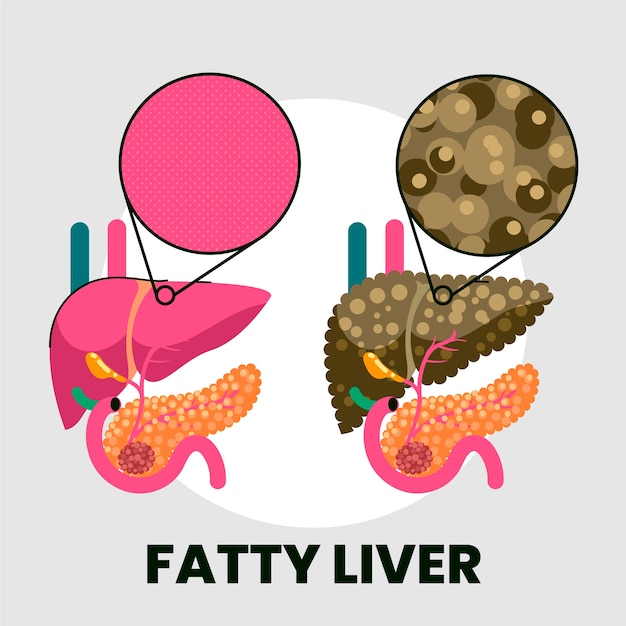Free vector hand drawn flat design fatty liver illustration
