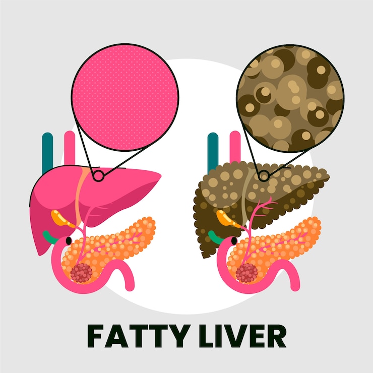 Free Vector hand drawn flat design fatty liver illustration