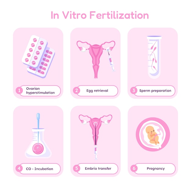 손으로 그린된 평면 디자인 ivf infographic