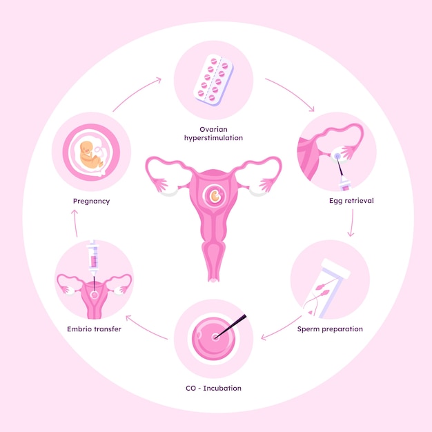 손으로 그린된 평면 디자인 ivf infographic