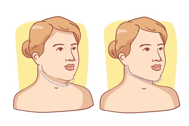 Hand drawn flat design liposuction illustration