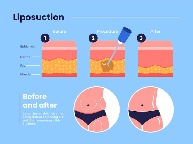 Vettore gratuito infografica per liposuzione design piatto disegnata a mano